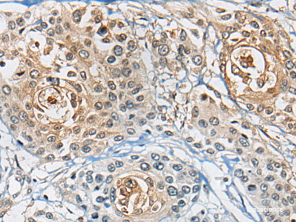 Immunohistochemistry of paraffin-embedded Human prost at e cancer tissue  using CD8A Polyclonal Antibody at dilution of 1:100(×200)