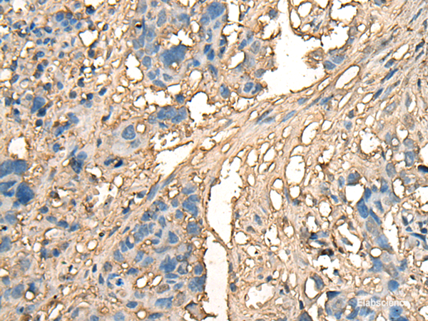 Immunohistochemistry of paraffin-embedded Human lung cancer tissue  using CELA1 Polyclonal Antibody at dilution of 1:70(×200)