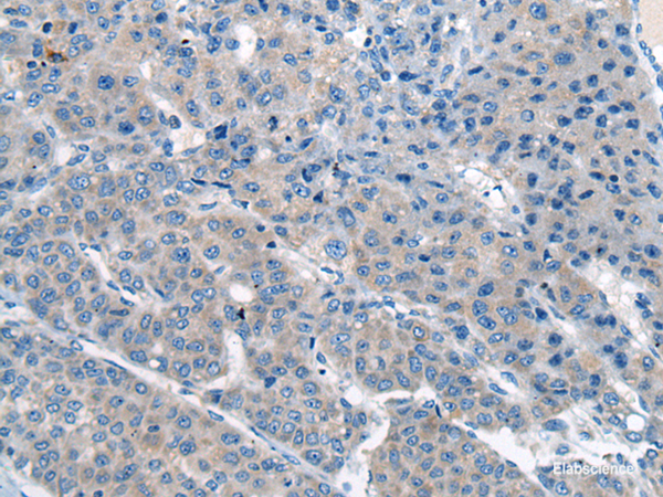 Immunohistochemistry of paraffin-embedded Human liver cancer tissue  using CITED4 Polyclonal Antibody at dilution of 1:65(×200)