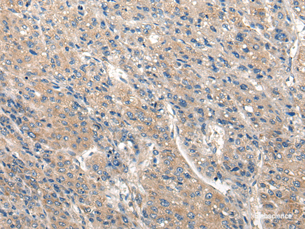 Immunohistochemistry of paraffin-embedded Human liver cancer tissue  using CLIC6 Polyclonal Antibody at dilution of 1:40(×200)