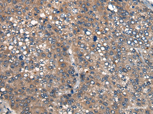 Immunohistochemistry of paraffin-embedded Human liver cancer tissue  using ICMT Polyclonal Antibody at dilution of 1:45(×200)