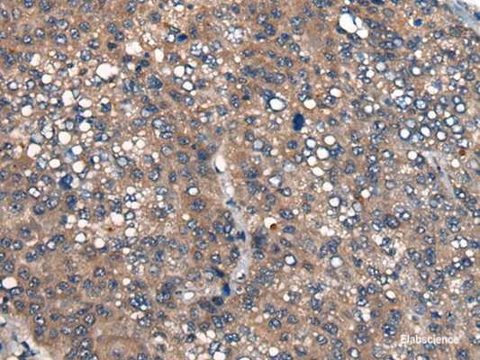 Immunohistochemistry of paraffin-embedded Human liver cancer tissue  using ICMT Polyclonal Antibody at dilution of 1:45(×200)