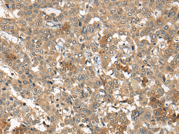 Immunohistochemistry of paraffin-embedded Human liver cancer tissue  using ARCN1 Polyclonal Antibody at dilution of 1:50(×200)