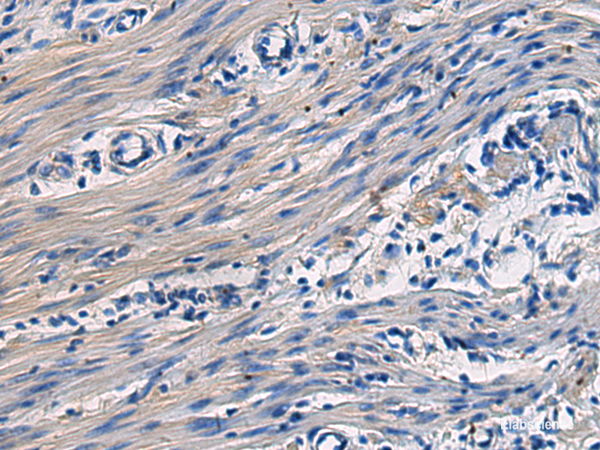 Immunohistochemistry of paraffin-embedded Human colorectal cancer tissue  using COL17A1 Polyclonal Antibody at dilution of 1:50(×200)