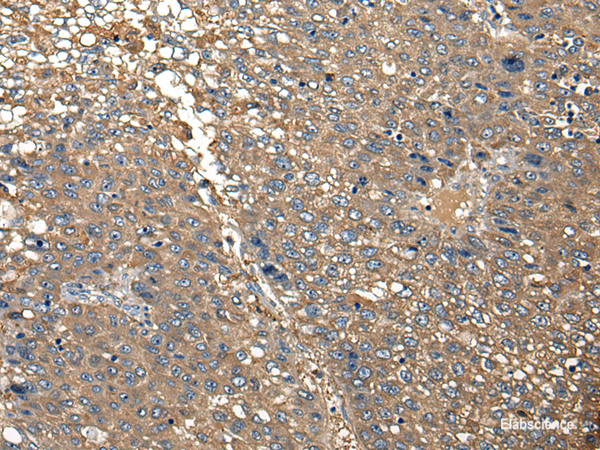 Immunohistochemistry of paraffin-embedded Human liver cancer tissue  using DGKI Polyclonal Antibody at dilution of 1:30(×200)