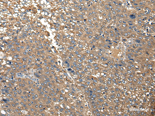 Immunohistochemistry of paraffin-embedded Human liver cancer tissue  using DGKI Polyclonal Antibody at dilution of 1:30(×200)