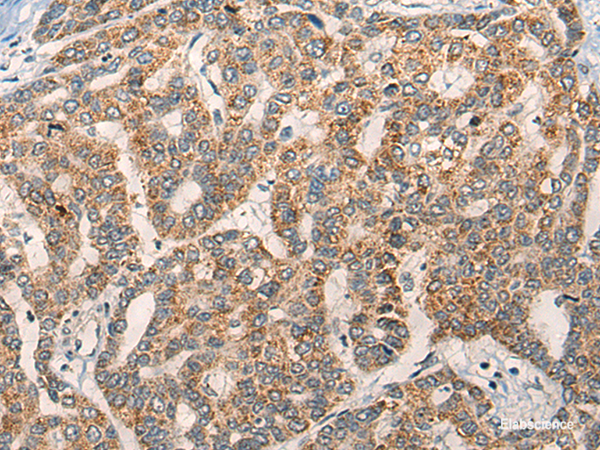 Immunohistochemistry of paraffin-embedded Human liver cancer tissue  using NLGN1 Polyclonal Antibody at dilution of 1:50(×200)