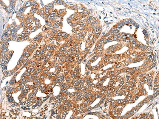 Immunohistochemistry of paraffin-embedded Human liver cancer tissue  using NOG Polyclonal Antibody at dilution of 1:40(×200)