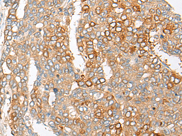 Immunohistochemistry of paraffin-embedded Human liver cancer tissue  using PCDHGB5 Polyclonal Antibody at dilution of 1:35(×200)