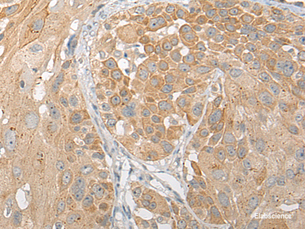 Immunohistochemistry of paraffin-embedded Human esophagus cancer tissue  using SNX6 Polyclonal Antibody at dilution of 1:50(×200)