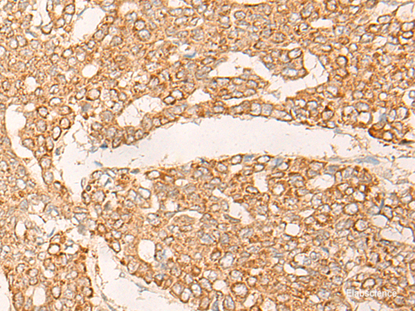 Immunohistochemistry of paraffin-embedded Human liver cancer tissue  using KRT9 Polyclonal Antibody at dilution of 1:30(×200)