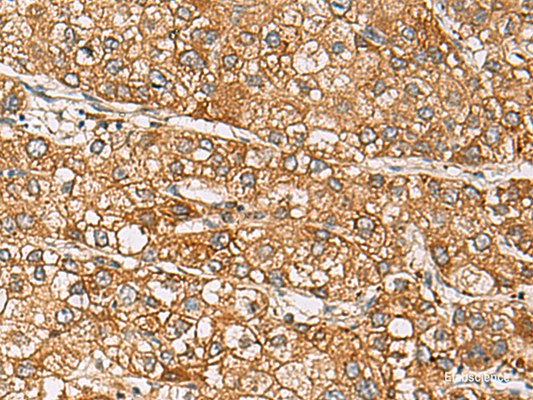 Immunohistochemistry of paraffin-embedded Human liver cancer tissue  using DCAF12 Polyclonal Antibody at dilution of 1:65(×200)