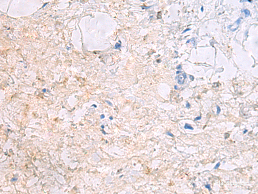 Immunohistochemistry of paraffin-embedded Human gastric cancer tissue  using DPCD Polyclonal Antibody at dilution of 1:50(×200)