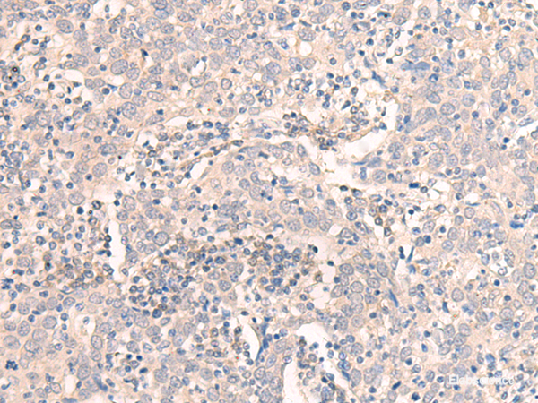 Immunohistochemistry of paraffin-embedded Human cervical cancer tissue  using EMX1 Polyclonal Antibody at dilution of 1:25(×200)