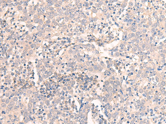 Immunohistochemistry of paraffin-embedded Human cervical cancer tissue  using EMX1 Polyclonal Antibody at dilution of 1:25(×200)