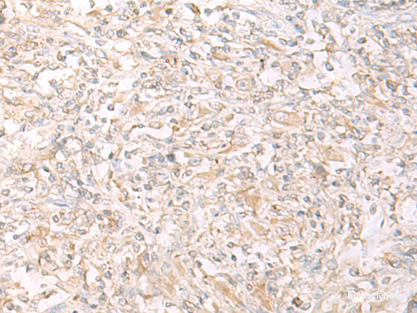 Immunohistochemistry of paraffin-embedded Human liver cancer tissue  using IL12B Polyclonal Antibody at dilution of 1:45(×200)
