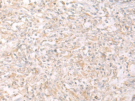 Immunohistochemistry of paraffin-embedded Human liver cancer tissue  using IL12B Polyclonal Antibody at dilution of 1:45(×200)