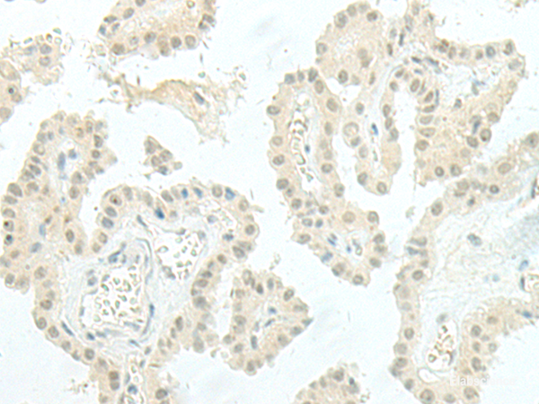 Immunohistochemistry of paraffin-embedded Human thyroid cancer tissue  using ESRP2 Polyclonal Antibody at dilution of 1:95(×200)