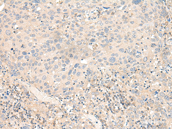Immunohistochemistry of paraffin-embedded Human cervical cancer tissue  using KCNA10 Polyclonal Antibody at dilution of 1:40(×200)