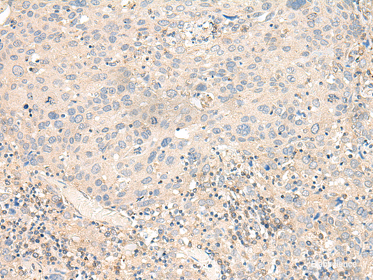 Immunohistochemistry of paraffin-embedded Human cervical cancer tissue  using KCNA10 Polyclonal Antibody at dilution of 1:40(×200)