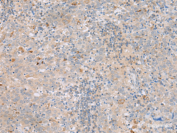 Immunohistochemistry of paraffin-embedded Human cervical cancer tissue  using SAXO2 Polyclonal Antibody at dilution of 1:45(×200)