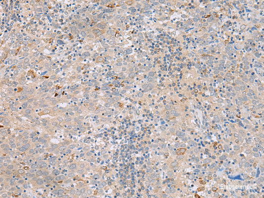 Immunohistochemistry of paraffin-embedded Human cervical cancer tissue  using SAXO2 Polyclonal Antibody at dilution of 1:45(×200)