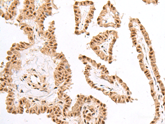 Immunohistochemistry of paraffin-embedded Human thyroid cancer tissue  using KDM2A Polyclonal Antibody at dilution of 1:60(×200)