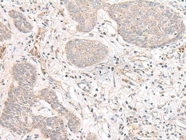 Immunohistochemistry of paraffin-embedded Human esophagus cancer tissue  using FBXW8 Polyclonal Antibody at dilution of 1:70(×200)