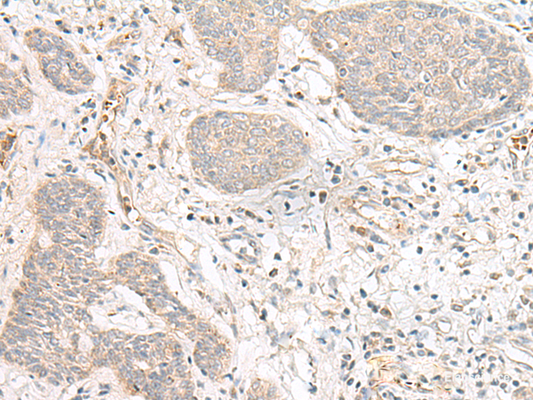 Immunohistochemistry of paraffin-embedded Human esophagus cancer tissue  using FBXW8 Polyclonal Antibody at dilution of 1:70(×200)