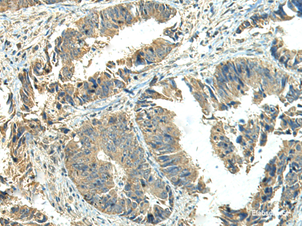 Immunohistochemistry of paraffin-embedded Human colorectal cancer tissue  using NPVF Polyclonal Antibody at dilution of 1:65(×200)