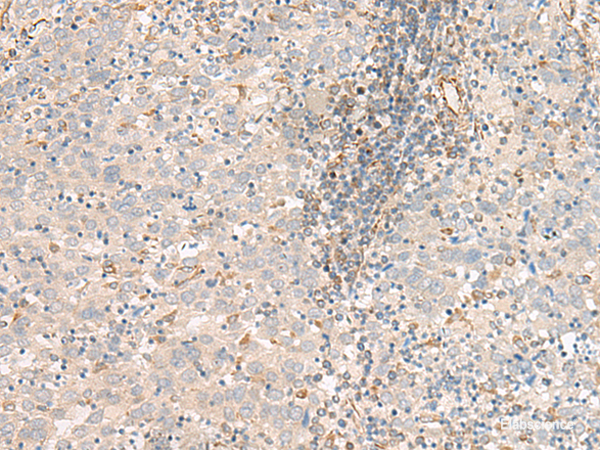Immunohistochemistry of paraffin-embedded Human cervical cancer tissue  using FER Polyclonal Antibody at dilution of 1:80(×200)
