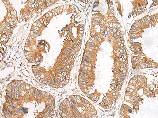Immunohistochemistry of paraffin-embedded Human colorectal cancer tissue  using FERD3L Polyclonal Antibody at dilution of 1:85(×200)