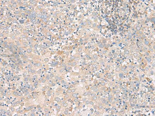 Immunohistochemistry of paraffin-embedded Human cervical cancer tissue  using FGF13 Polyclonal Antibody at dilution of 1:45(×200)
