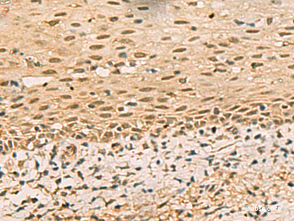 Immunohistochemistry of paraffin-embedded Human cervical cancer tissue  using FOXH1 Polyclonal Antibody at dilution of 1:40(×200)