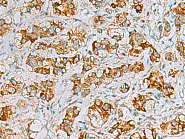Immunohistochemistry of paraffin-embedded Human liver cancer tissue  using FAAP100 Polyclonal Antibody at dilution of 1:40(×200)