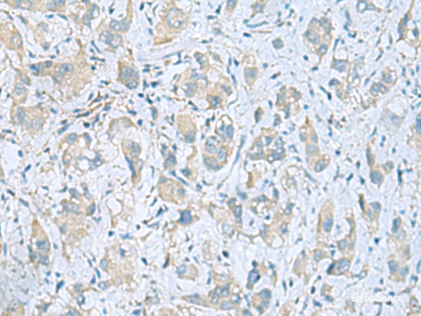 Immunohistochemistry of paraffin-embedded Human liver cancer tissue  using PLN Polyclonal Antibody at dilution of 1:45(×200)