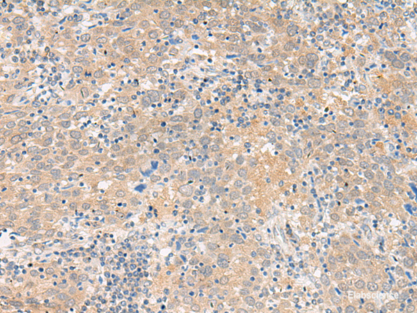 Immunohistochemistry of paraffin-embedded Human cervical cancer tissue  using GALP Polyclonal Antibody at dilution of 1:45(×200)