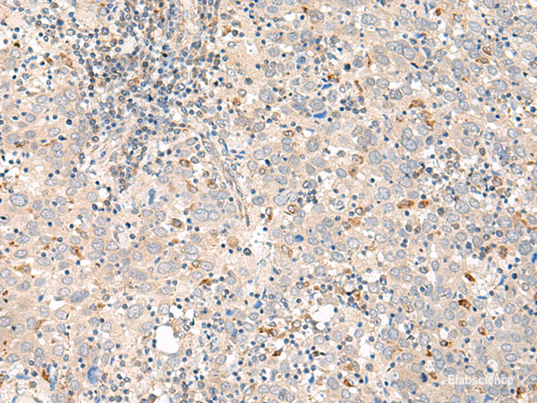 Immunohistochemistry of paraffin-embedded Human cervical cancer tissue  using GALR1 Polyclonal Antibody at dilution of 1:60(×200)