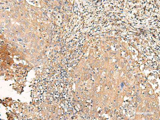 Immunohistochemistry of paraffin-embedded Human cervical cancer tissue  using GALR2 Polyclonal Antibody at dilution of 1:25(×200)