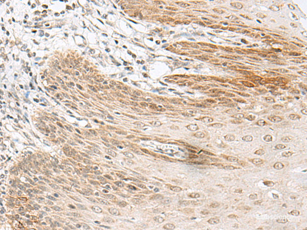 Immunohistochemistry of paraffin-embedded Human esophagus cancer tissue  using RALGAPA1 Polyclonal Antibody at dilution of 1:55(×200)