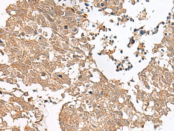 Immunohistochemistry of paraffin-embedded Human lung cancer tissue  using GRASP Polyclonal Antibody at dilution of 1:60(×200)