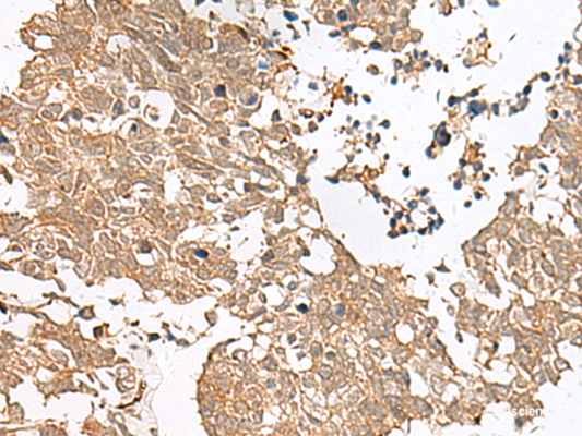 Immunohistochemistry of paraffin-embedded Human lung cancer tissue  using GRASP Polyclonal Antibody at dilution of 1:60(×200)