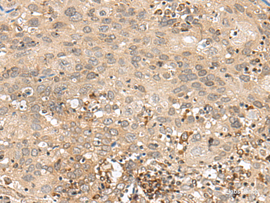 Immunohistochemistry of paraffin-embedded Human cervical cancer tissue  using GFI1 Polyclonal Antibody at dilution of 1:60(×200)