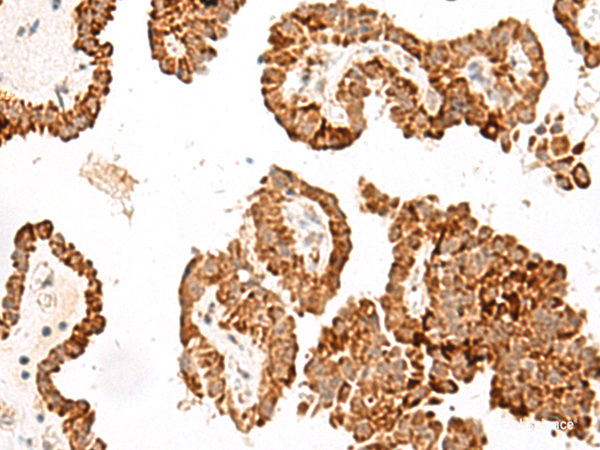 Immunohistochemistry of paraffin-embedded Human thyroid cancer tissue  using GFI1B Polyclonal Antibody at dilution of 1:40(×200)