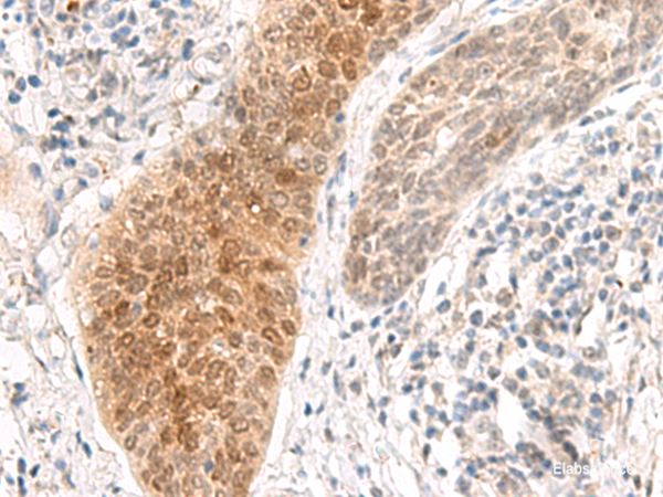 Immunohistochemistry of paraffin-embedded Human esophagus cancer tissue  using GHDC Polyclonal Antibody at dilution of 1:90(×200)