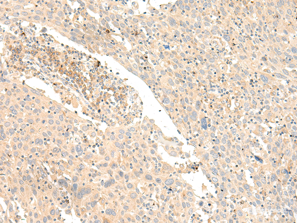 Immunohistochemistry of paraffin-embedded Human cervical cancer tissue  using GLIS1 Polyclonal Antibody at dilution of 1:40(×200)