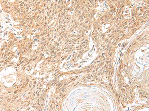 Immunohistochemistry of paraffin-embedded Human esophagus cancer tissue  using BICRA Polyclonal Antibody at dilution of 1:60(×200)
