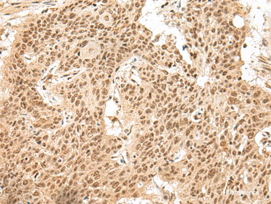 Immunohistochemistry of paraffin-embedded Human esophagus cancer tissue  using GMEB2 Polyclonal Antibody at dilution of 1:30(×200)