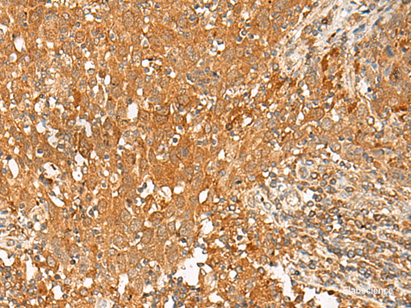 Immunohistochemistry of paraffin-embedded Human cervical cancer tissue  using GPR1 Polyclonal Antibody at dilution of 1:50(×200)