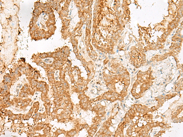 Immunohistochemistry of paraffin-embedded Human thyroid cancer tissue  using ADGRF1 Polyclonal Antibody at dilution of 1:25(×200)